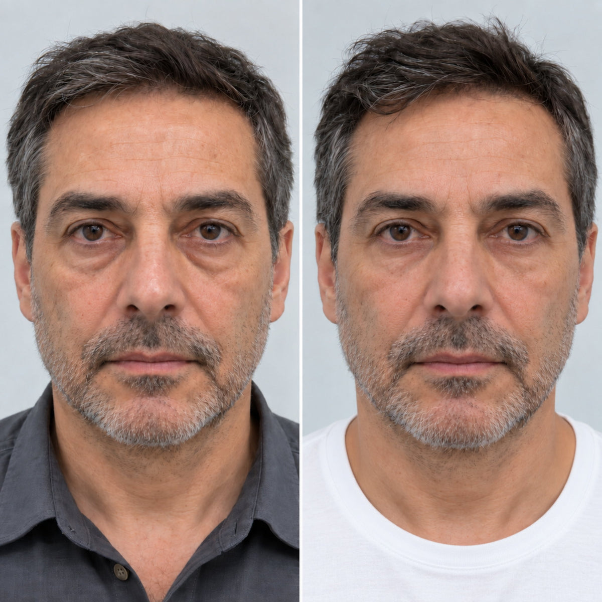 Antes y después de relleno de ojeras con ácido hialurónico en paciente hombre