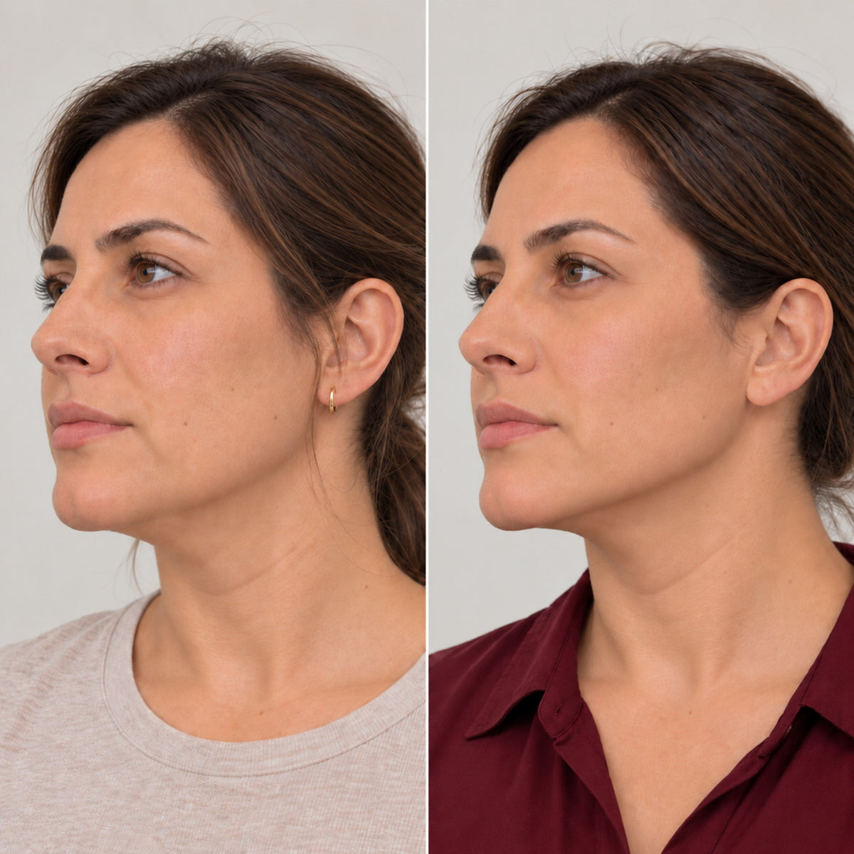 Antes y después del perfilado de borde mandibular en paciente mujer
