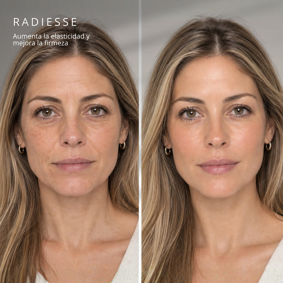 Radiesse® Bioestimulador de Colágeno