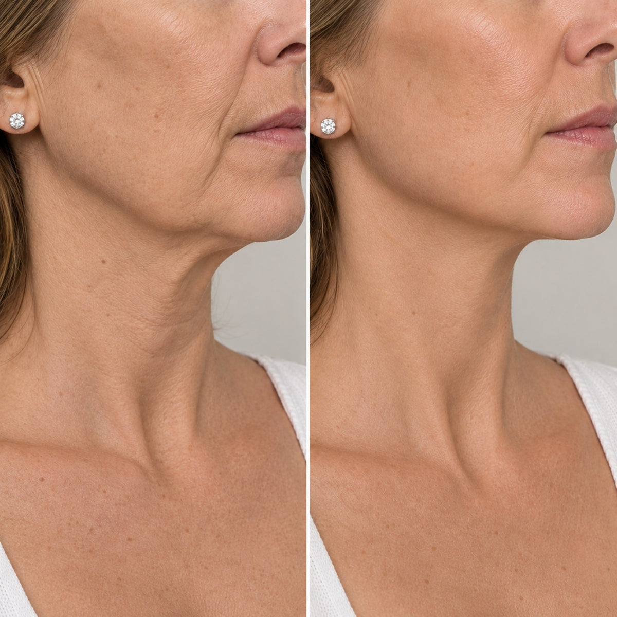 Radiesse® Bioestimulador de Colágeno